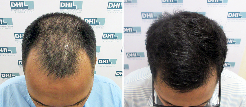 DHI before & after hair transplant results